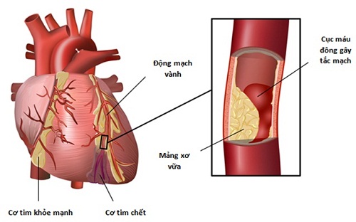 Nói không với MÁU NHIỄM MỠ nhờ NẤM LINH CHI