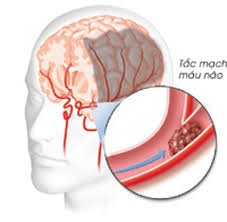 Đông y điều trị di chứng tai biến mạch máu não (Đột quỵ)