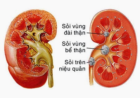 Sỏi thận nên và không nên ăn gì